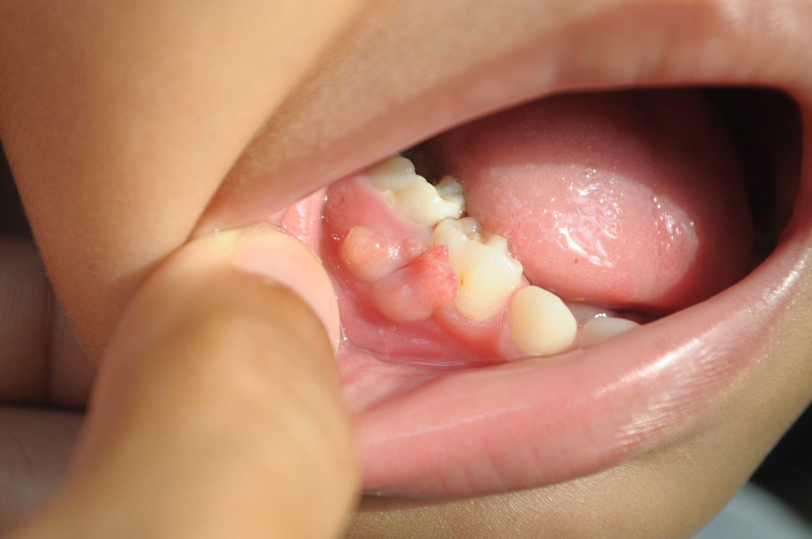 Close up picture of a gum boil